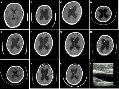 Management of long-term cryptococcal meningitis neoformans in a surviving patient: A case report